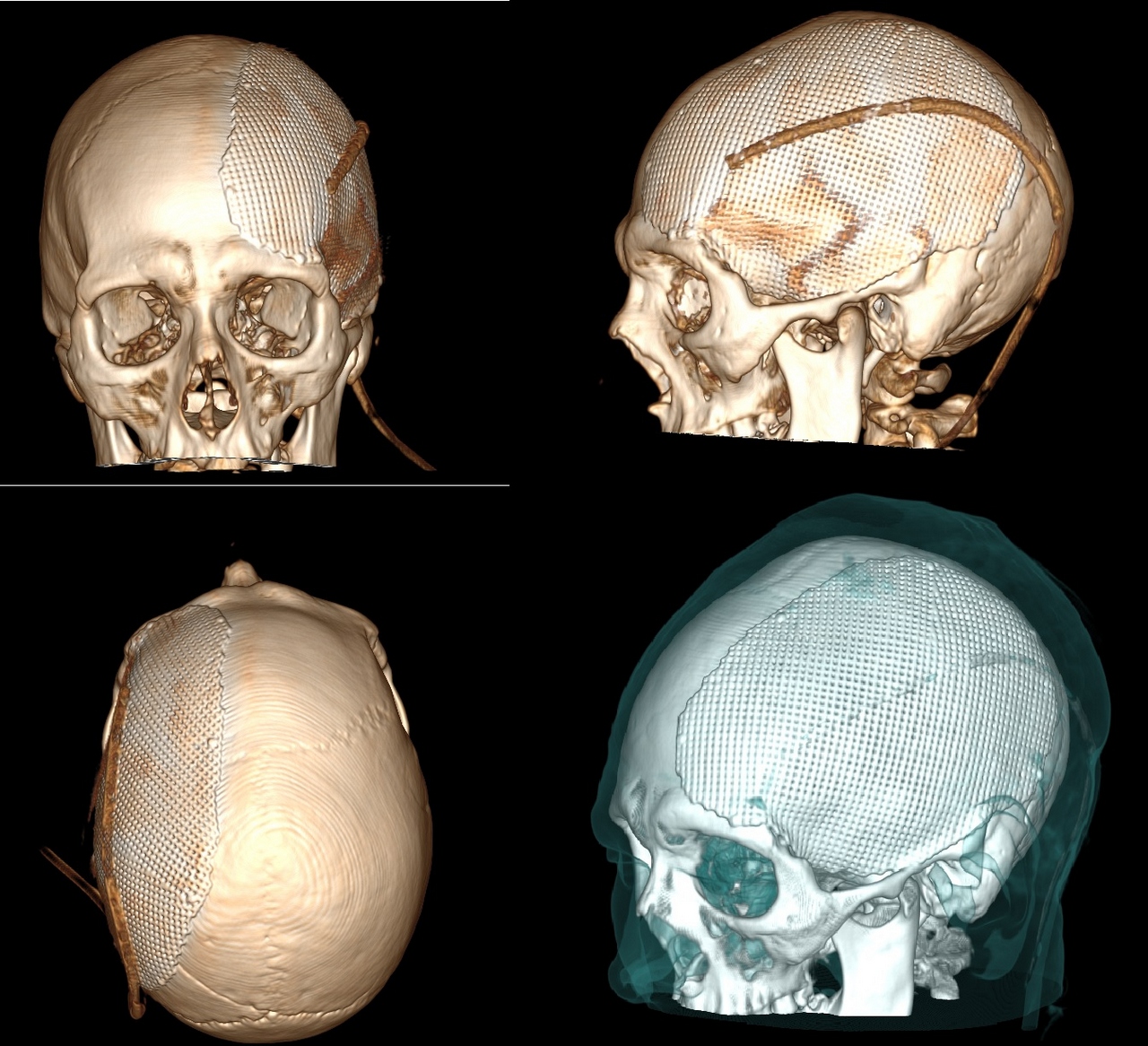 Тагильские врачи восстановили кости черепа пострадавшего в ДТП мужчины при помощи 3D-моделируемого импланта